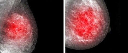 سرطان الثدي.. علاماته, أسبابه, أنواعه و تشخيص المرض